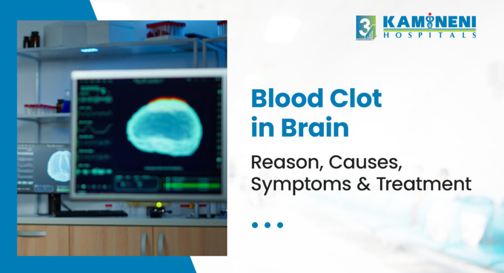 blood clot in brain